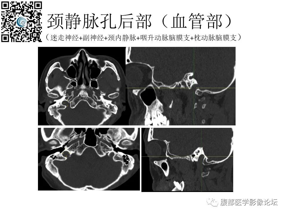 影像PPT - 【PPT】颅骨颅底系列之岩洞深处住神仙-87