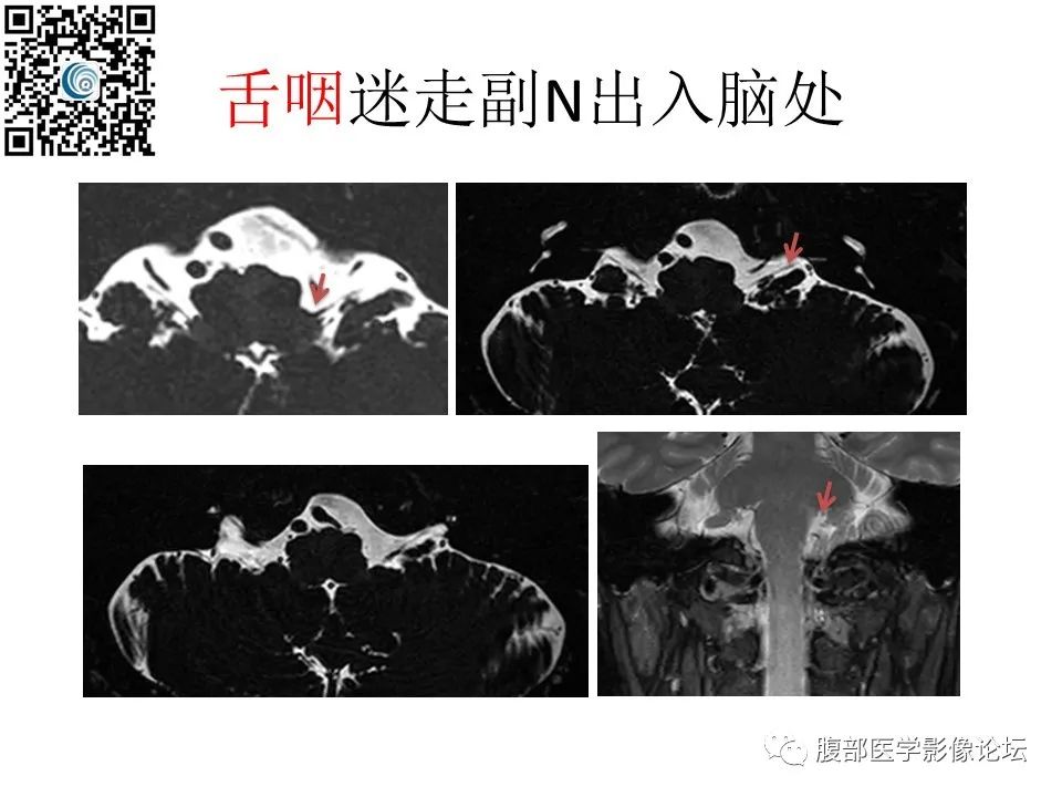 影像PPT - 【PPT】颅骨颅底系列之岩洞深处住神仙-89