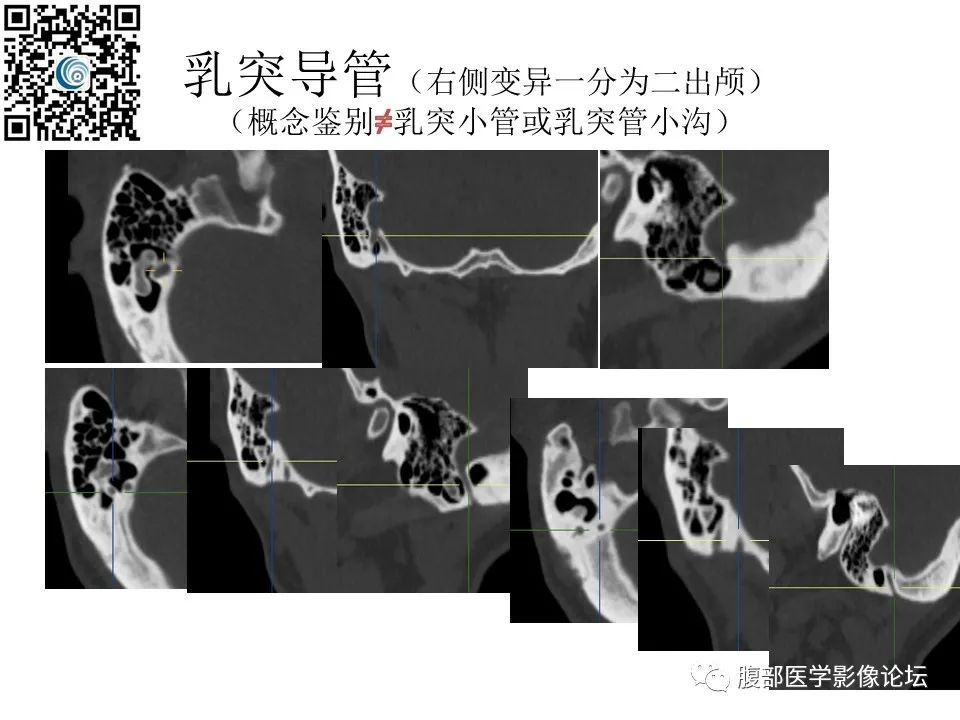 影像PPT - 【PPT】颅骨颅底系列之岩洞深处住神仙-94