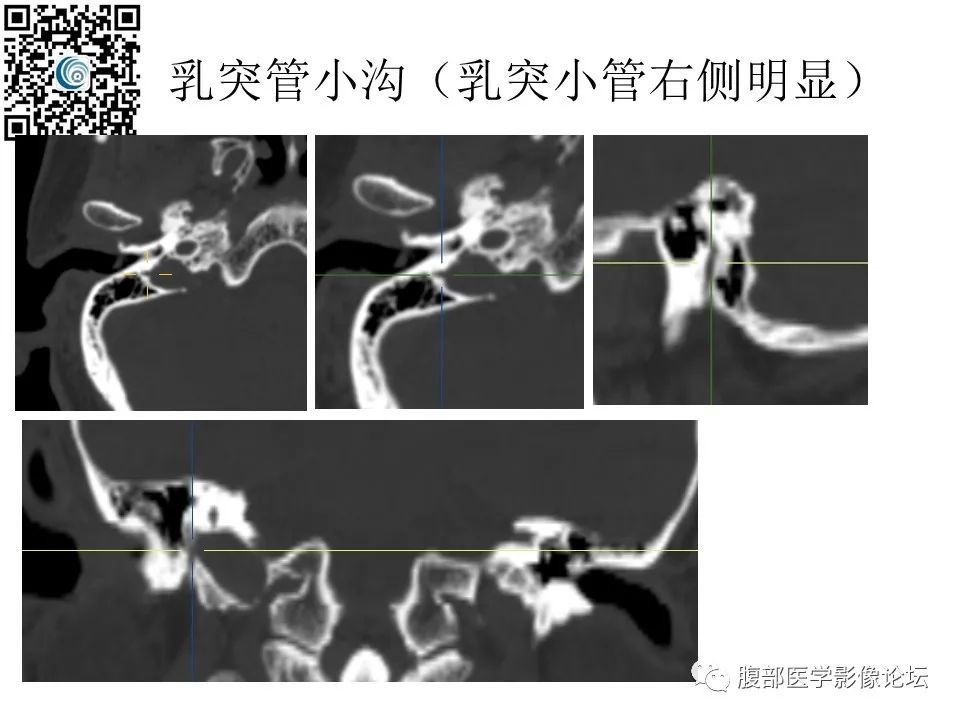 影像PPT - 【PPT】颅骨颅底系列之岩洞深处住神仙-92