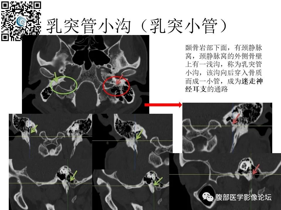 影像PPT - 【PPT】颅骨颅底系列之岩洞深处住神仙-90