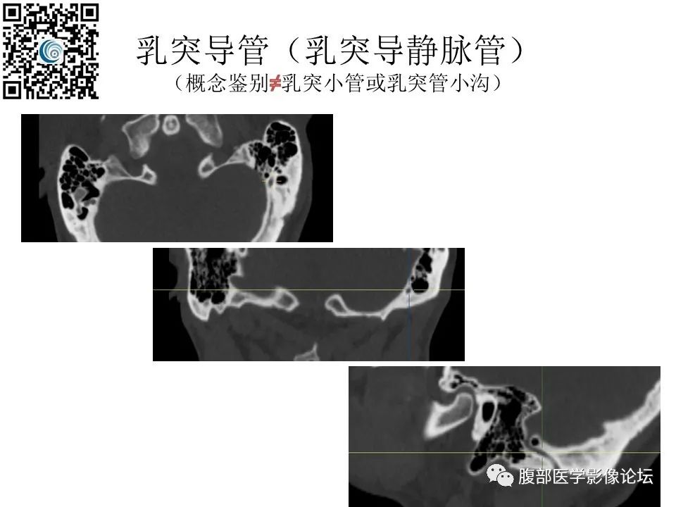 影像PPT - 【PPT】颅骨颅底系列之岩洞深处住神仙-93