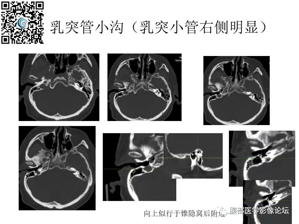 影像PPT - 【PPT】颅骨颅底系列之岩洞深处住神仙-91