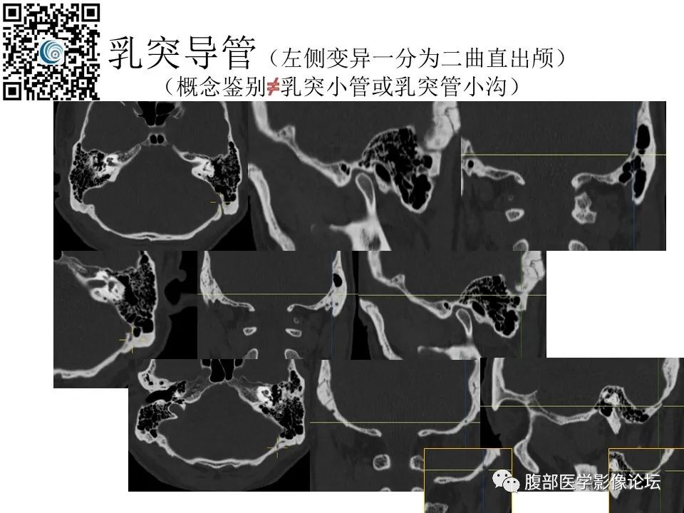 影像PPT - 【PPT】颅骨颅底系列之岩洞深处住神仙-95