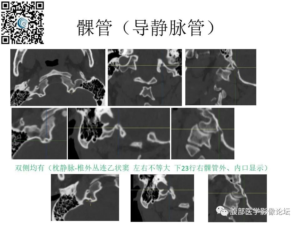 影像PPT - 【PPT】颅骨颅底系列之岩洞深处住神仙-98