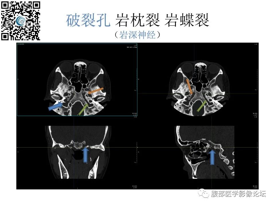 影像PPT - 【PPT】颅骨颅底系列之岩洞深处住神仙-100