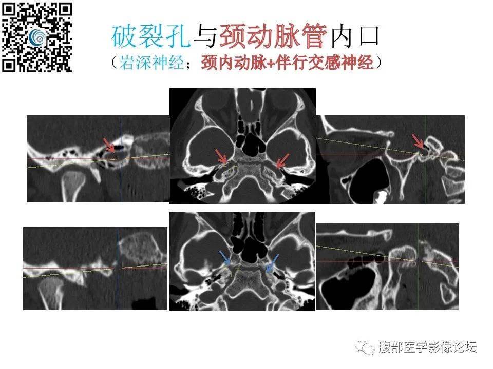 影像PPT - 【PPT】颅骨颅底系列之岩洞深处住神仙-99