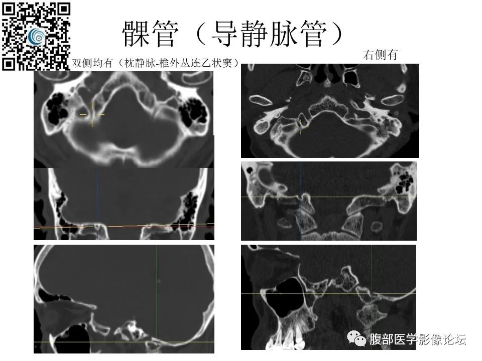 影像PPT - 【PPT】颅骨颅底系列之岩洞深处住神仙-97