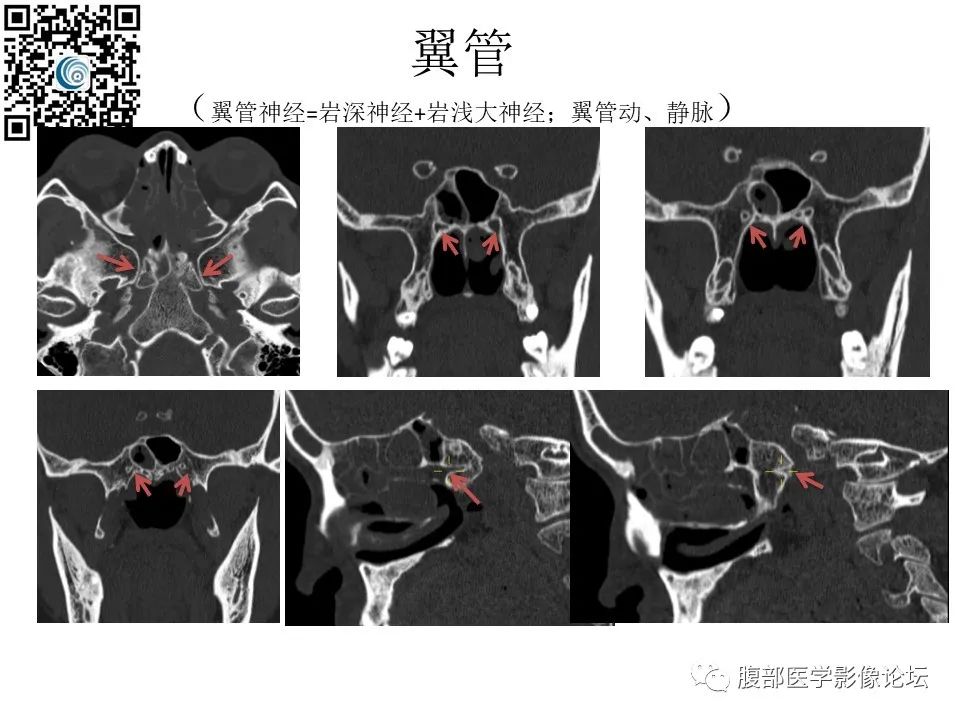 影像PPT - 【PPT】颅骨颅底系列之岩洞深处住神仙-101