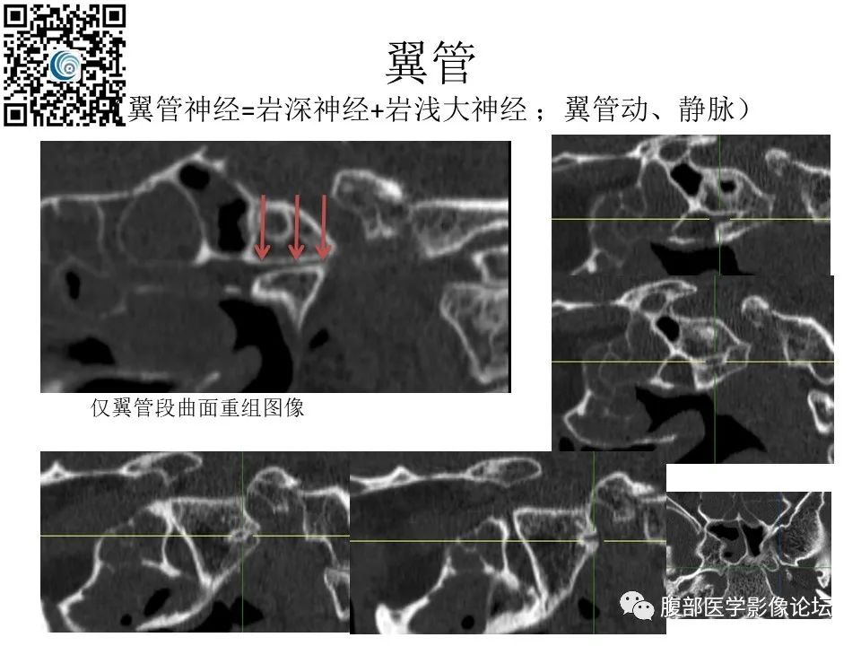 影像PPT - 【PPT】颅骨颅底系列之岩洞深处住神仙-102