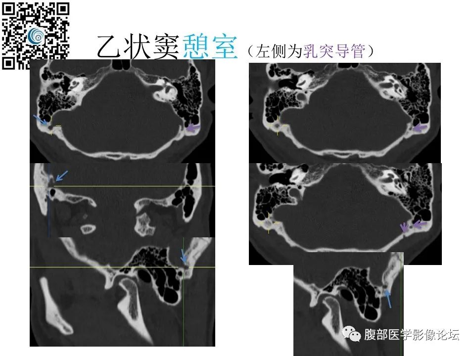 影像PPT - 【PPT】颅骨颅底系列之岩洞深处住神仙-96