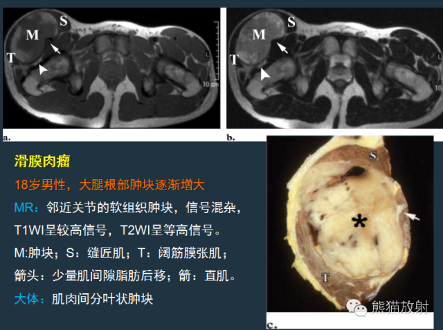 影像PPT - 【病例】小腿滑膜肉瘤1例CT及MR影像-5