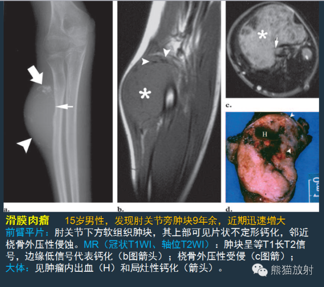 影像PPT - 【病例】小腿滑膜肉瘤1例CT及MR影像-6