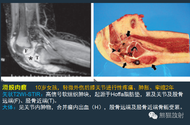 影像PPT - 【病例】小腿滑膜肉瘤1例CT及MR影像-8