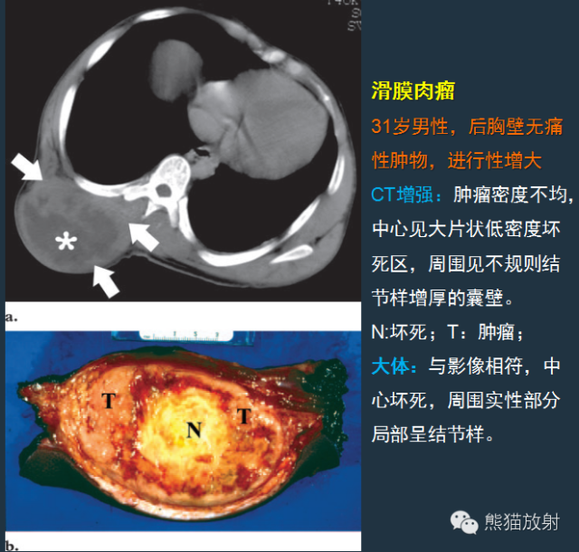 影像PPT - 【病例】小腿滑膜肉瘤1例CT及MR影像-7