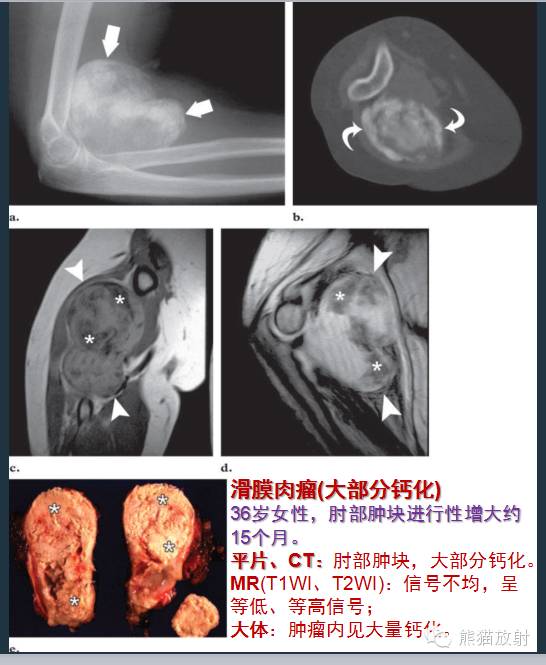 影像PPT - 【病例】小腿滑膜肉瘤1例CT及MR影像-11