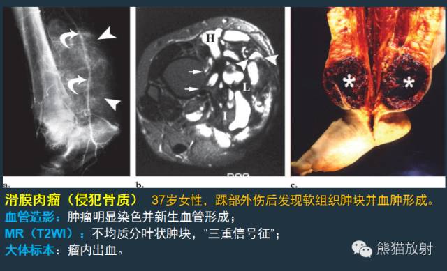 影像PPT - 【病例】小腿滑膜肉瘤1例CT及MR影像-15