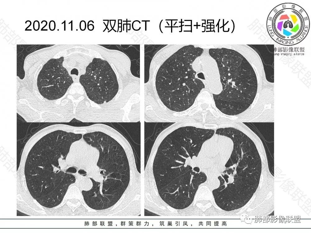 影像PPT - 【病例】鉴别肺脓肿与肺鳞癌——寻蛛丝马迹-9 影像PPT - 【病例】鉴别肺脓肿与肺鳞癌——寻蛛丝马迹-9