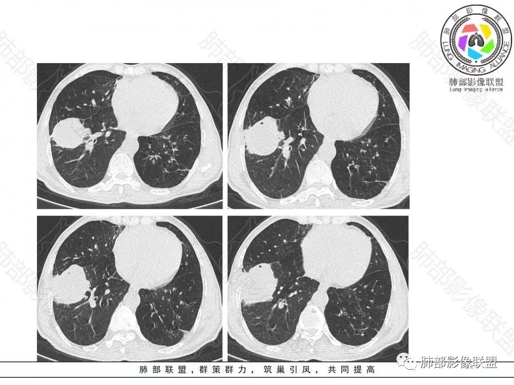 影像PPT - 【病例】鉴别肺脓肿与肺鳞癌——寻蛛丝马迹-11 影像PPT - 【病例】鉴别肺脓肿与肺鳞癌——寻蛛丝马迹-11
