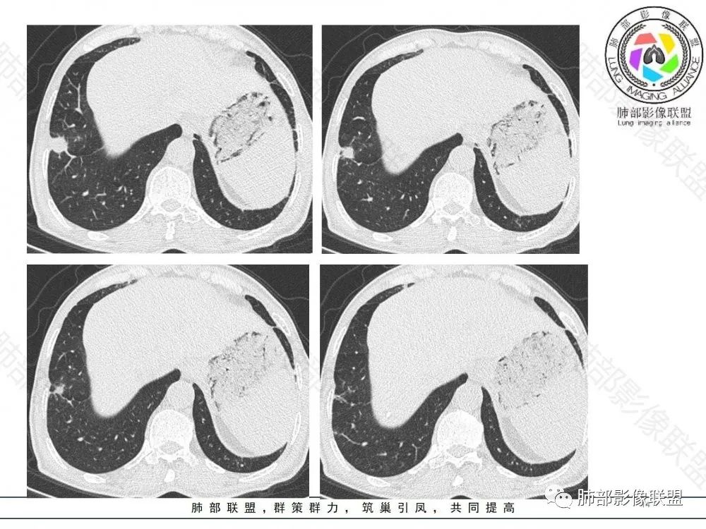 影像PPT - 【病例】鉴别肺脓肿与肺鳞癌——寻蛛丝马迹-14 影像PPT - 【病例】鉴别肺脓肿与肺鳞癌——寻蛛丝马迹-14