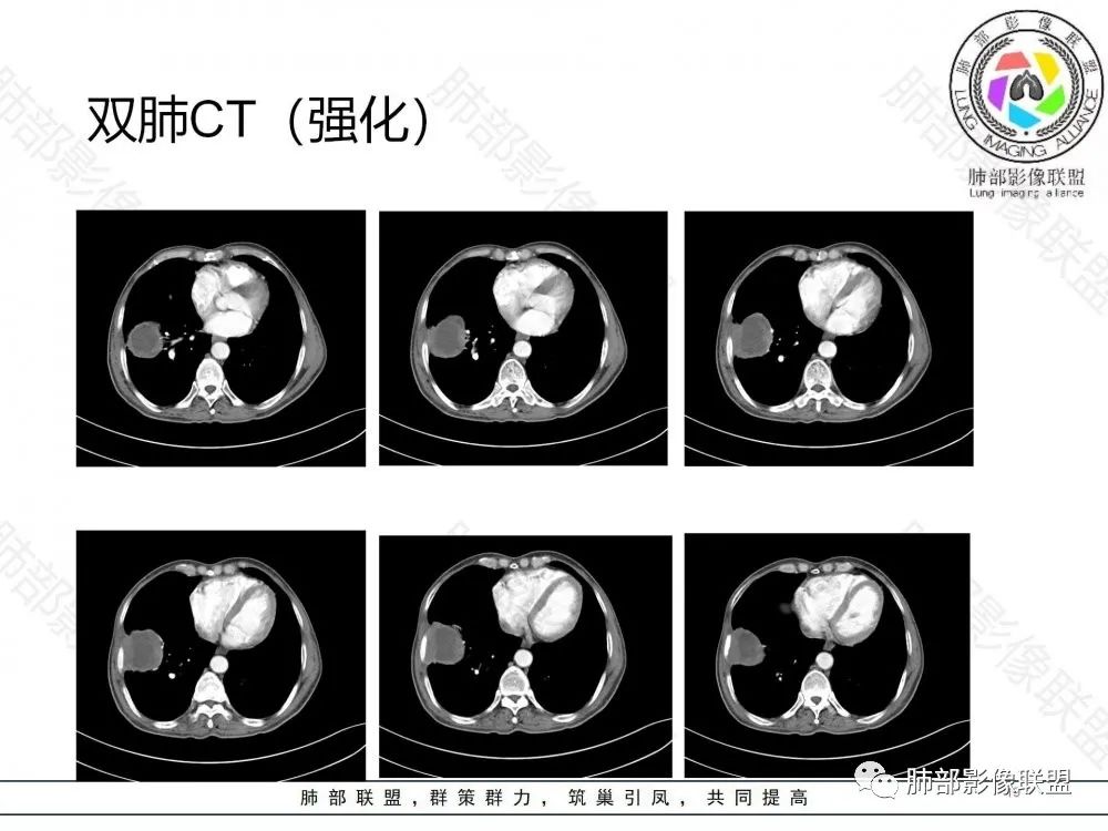 影像PPT - 【病例】鉴别肺脓肿与肺鳞癌——寻蛛丝马迹-19 影像PPT - 【病例】鉴别肺脓肿与肺鳞癌——寻蛛丝马迹-19