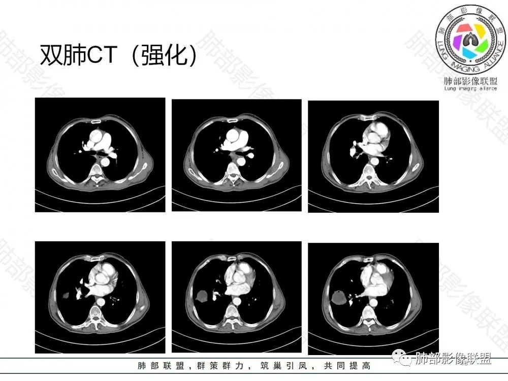 影像PPT - 【病例】鉴别肺脓肿与肺鳞癌——寻蛛丝马迹-18 影像PPT - 【病例】鉴别肺脓肿与肺鳞癌——寻蛛丝马迹-18