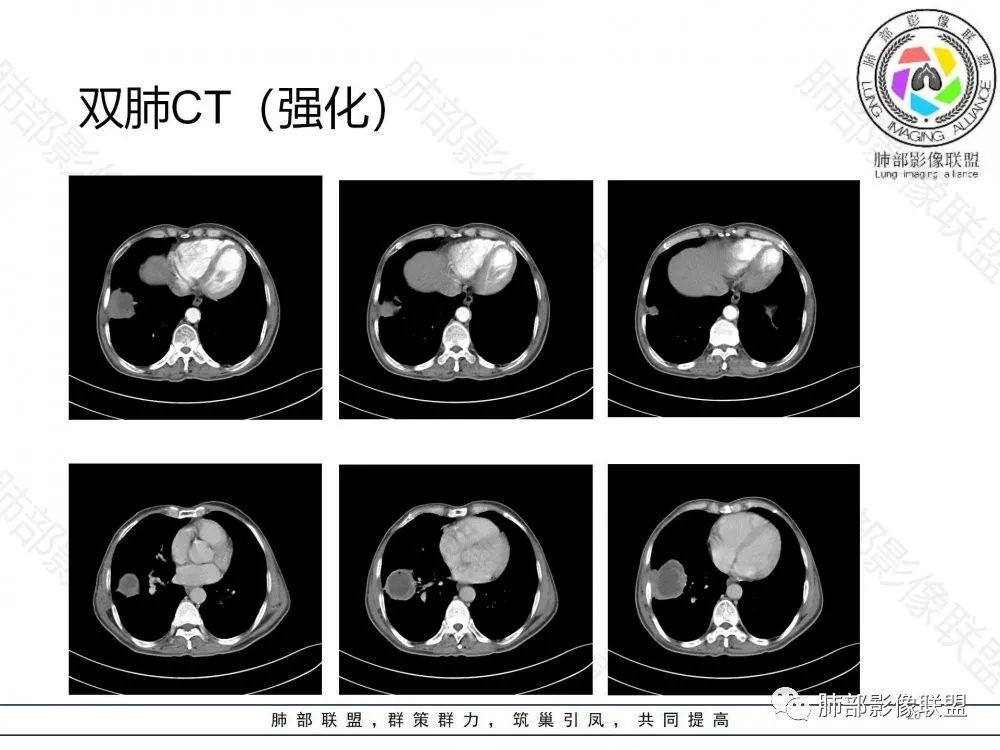 影像PPT - 【病例】鉴别肺脓肿与肺鳞癌——寻蛛丝马迹-20 影像PPT - 【病例】鉴别肺脓肿与肺鳞癌——寻蛛丝马迹-20
