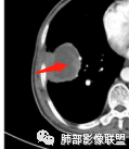 影像PPT - 【病例】鉴别肺脓肿与肺鳞癌——寻蛛丝马迹-23 影像PPT - 【病例】鉴别肺脓肿与肺鳞癌——寻蛛丝马迹-23