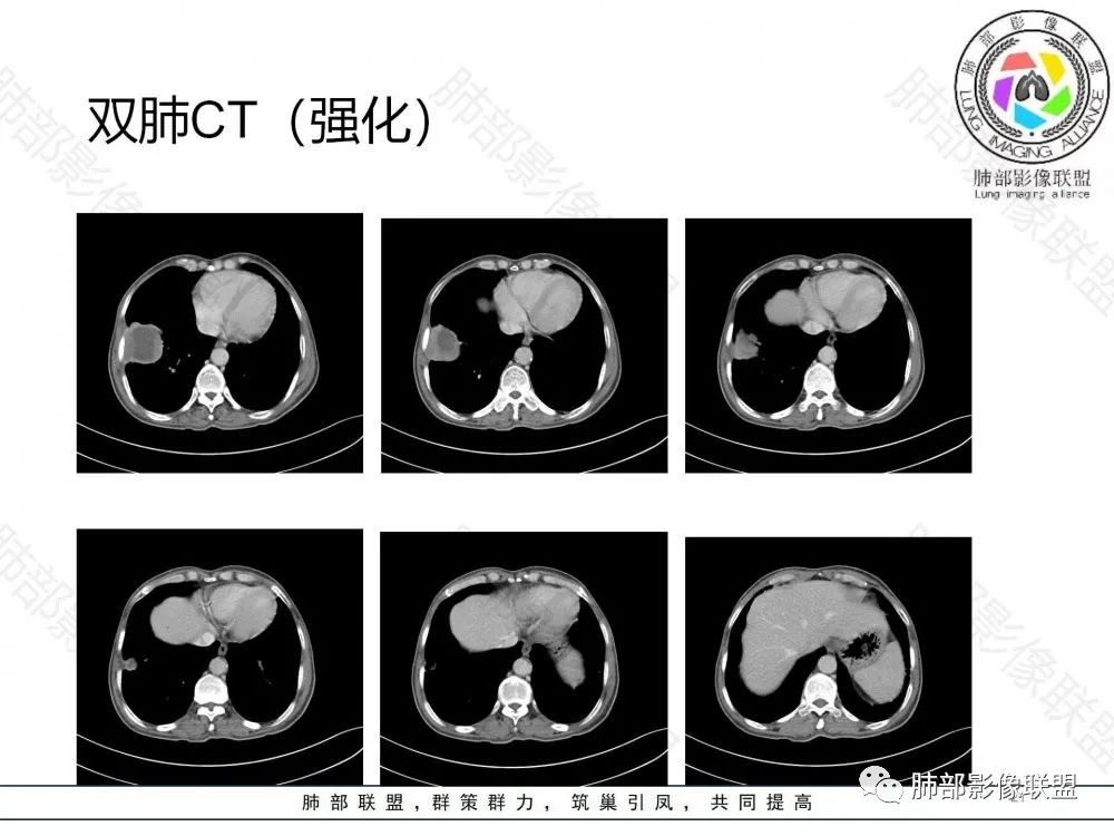 影像PPT - 【病例】鉴别肺脓肿与肺鳞癌——寻蛛丝马迹-21 影像PPT - 【病例】鉴别肺脓肿与肺鳞癌——寻蛛丝马迹-21