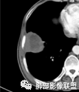 影像PPT - 【病例】鉴别肺脓肿与肺鳞癌——寻蛛丝马迹-26 影像PPT - 【病例】鉴别肺脓肿与肺鳞癌——寻蛛丝马迹-26