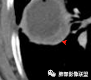 影像PPT - 【病例】鉴别肺脓肿与肺鳞癌——寻蛛丝马迹-28 影像PPT - 【病例】鉴别肺脓肿与肺鳞癌——寻蛛丝马迹-28