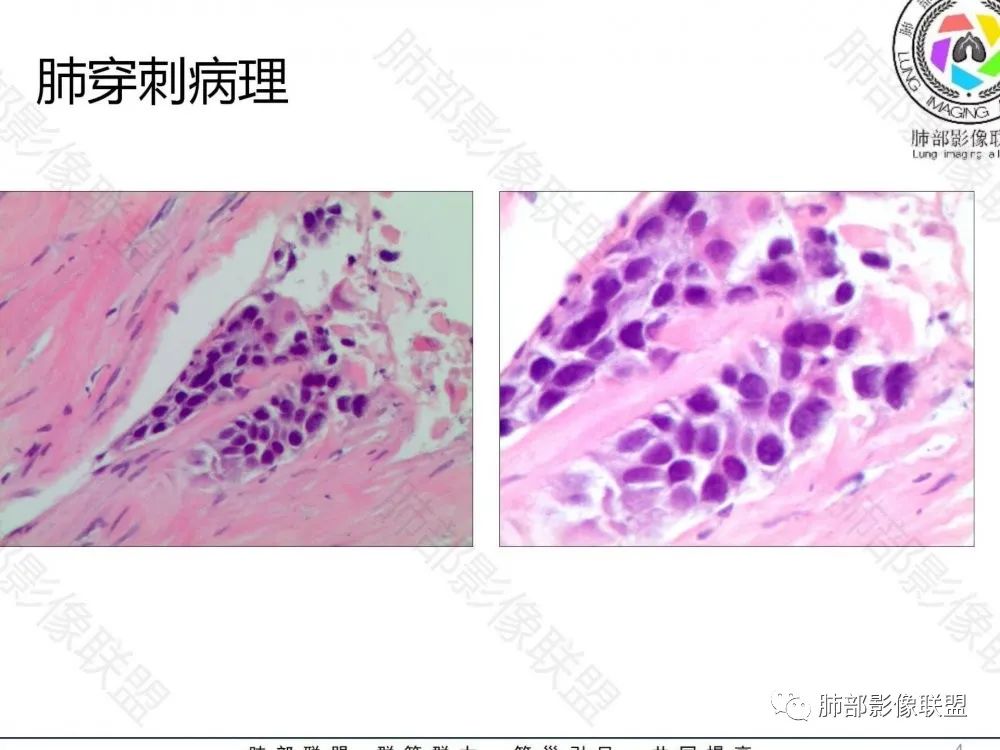 影像PPT - 【病例】鉴别肺脓肿与肺鳞癌——寻蛛丝马迹-33 影像PPT - 【病例】鉴别肺脓肿与肺鳞癌——寻蛛丝马迹-33
