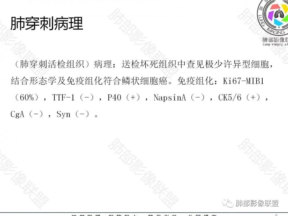 影像PPT - 【病例】鉴别肺脓肿与肺鳞癌——寻蛛丝马迹-34 影像PPT - 【病例】鉴别肺脓肿与肺鳞癌——寻蛛丝马迹-34