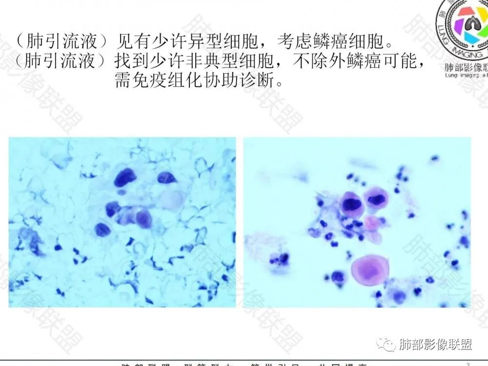 影像PPT - 【病例】鉴别肺脓肿与肺鳞癌——寻蛛丝马迹-32 影像PPT - 【病例】鉴别肺脓肿与肺鳞癌——寻蛛丝马迹-32