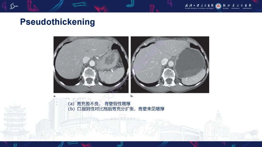 影像PPT - 【PPT】胃癌淋巴引流及TNM分期-8