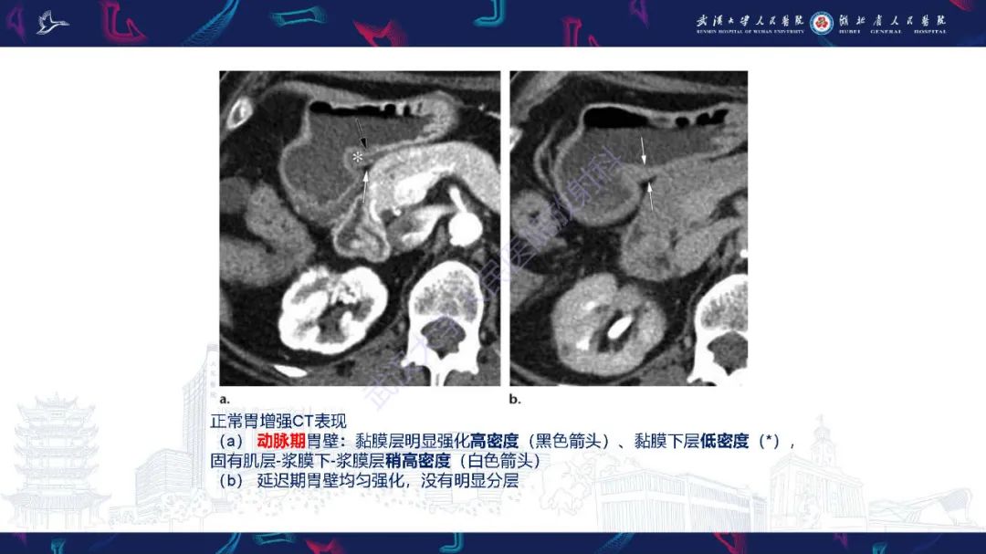 影像PPT - 【PPT】胃癌淋巴引流及TNM分期-9
