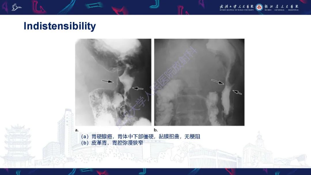 影像PPT - 【PPT】胃癌淋巴引流及TNM分期-16