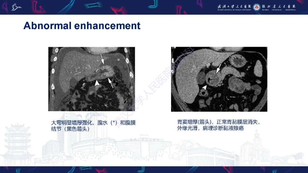 影像PPT - 【PPT】胃癌淋巴引流及TNM分期-17