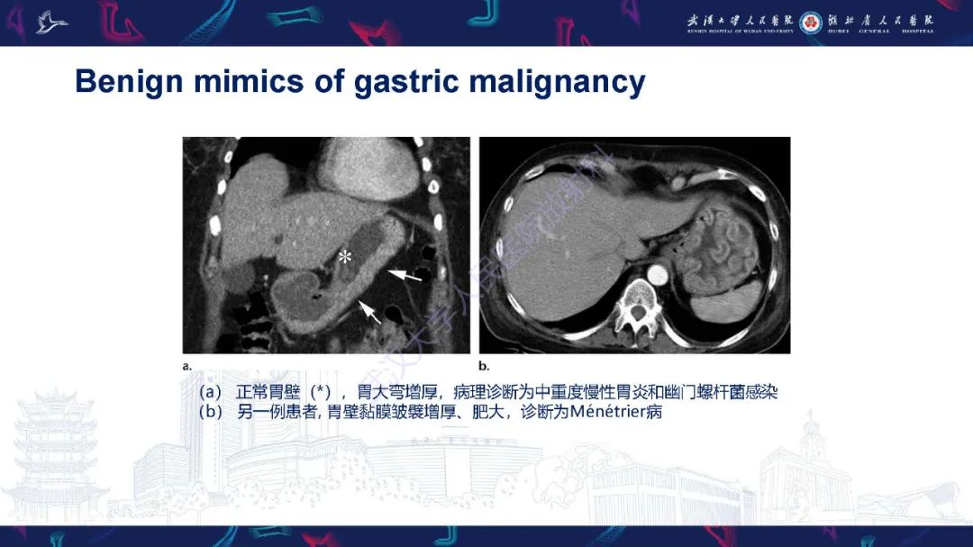 影像PPT - 【PPT】胃癌淋巴引流及TNM分期-18