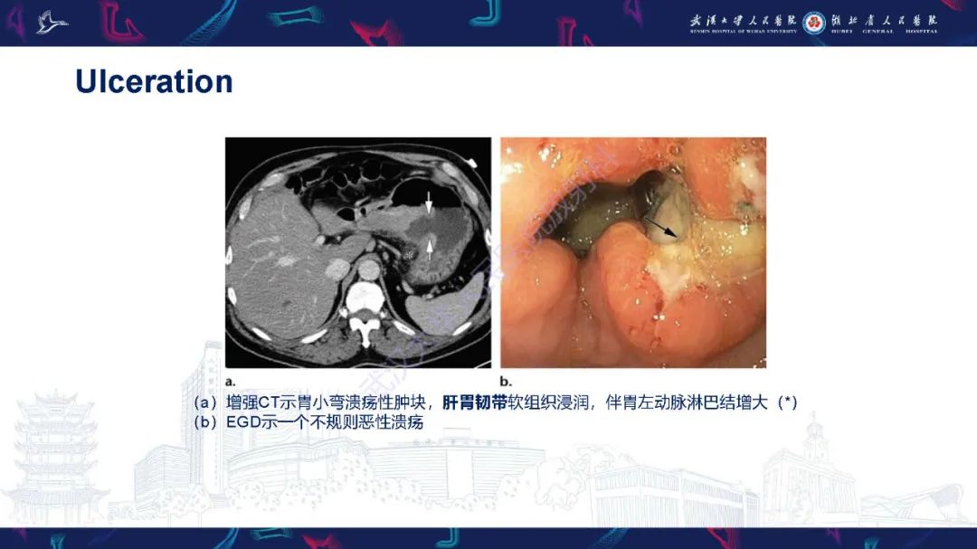 影像PPT - 【PPT】胃癌淋巴引流及TNM分期-21