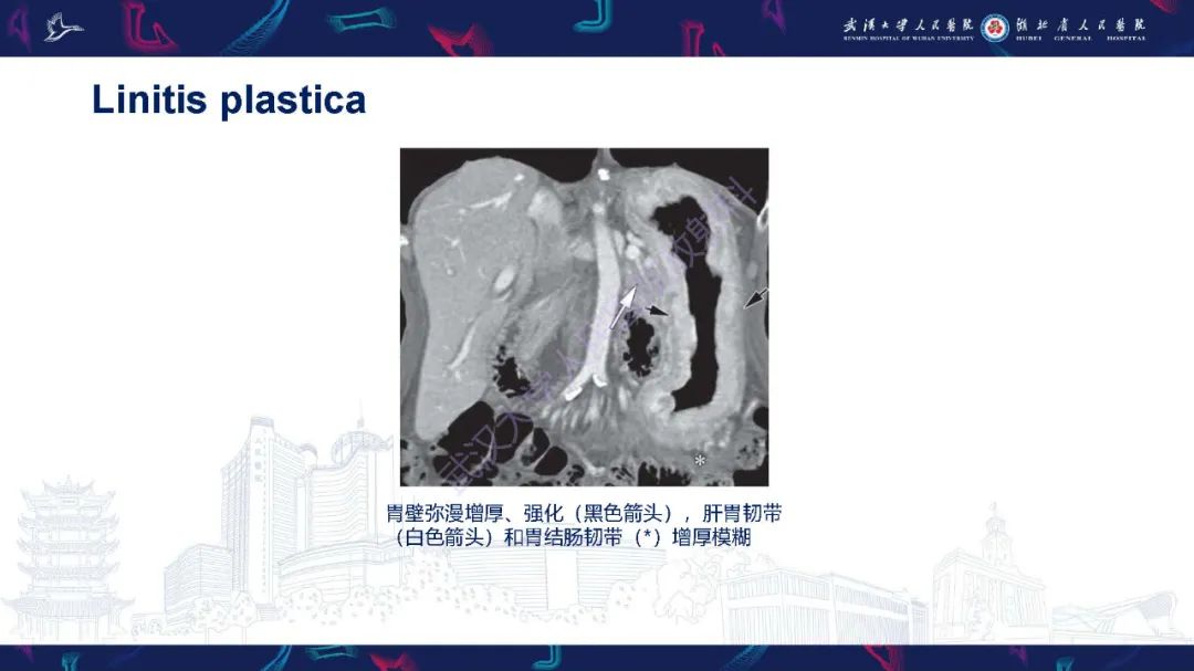 影像PPT - 【PPT】胃癌淋巴引流及TNM分期-19