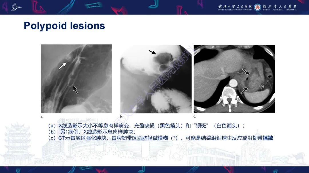 影像PPT - 【PPT】胃癌淋巴引流及TNM分期-20