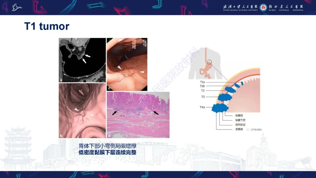 影像PPT - 【PPT】胃癌淋巴引流及TNM分期-25