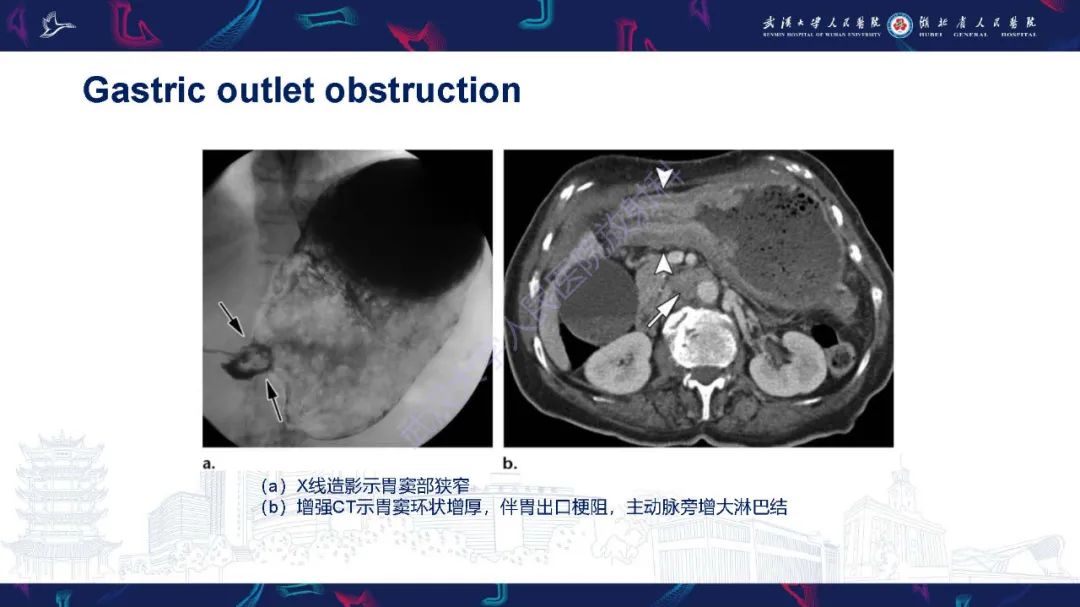 影像PPT - 【PPT】胃癌淋巴引流及TNM分期-22