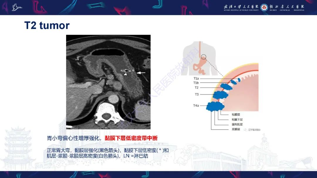影像PPT - 【PPT】胃癌淋巴引流及TNM分期-26
