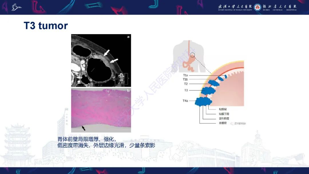 影像PPT - 【PPT】胃癌淋巴引流及TNM分期-27