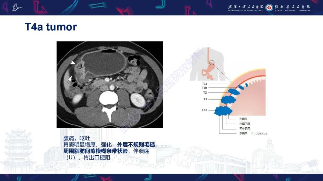 影像PPT - 【PPT】胃癌淋巴引流及TNM分期-28