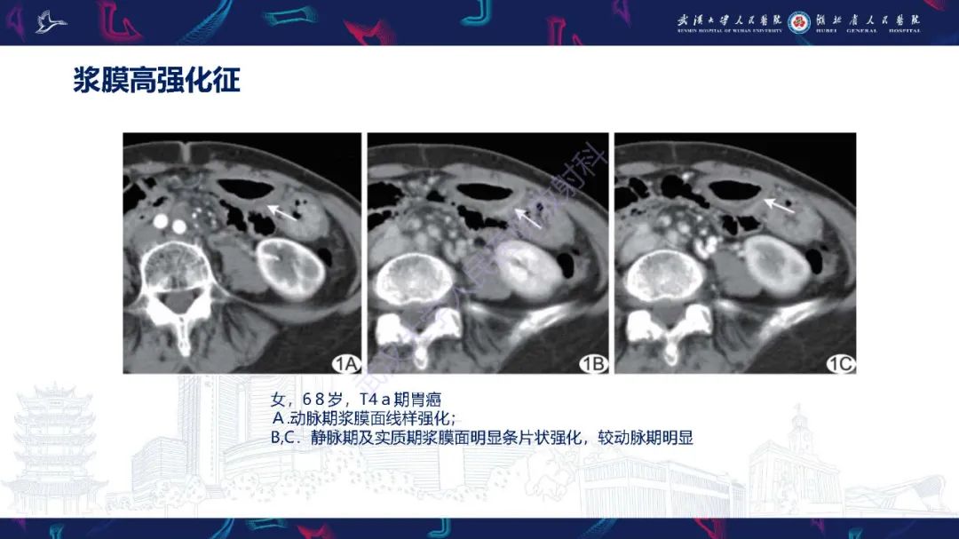 影像PPT - 【PPT】胃癌淋巴引流及TNM分期-29