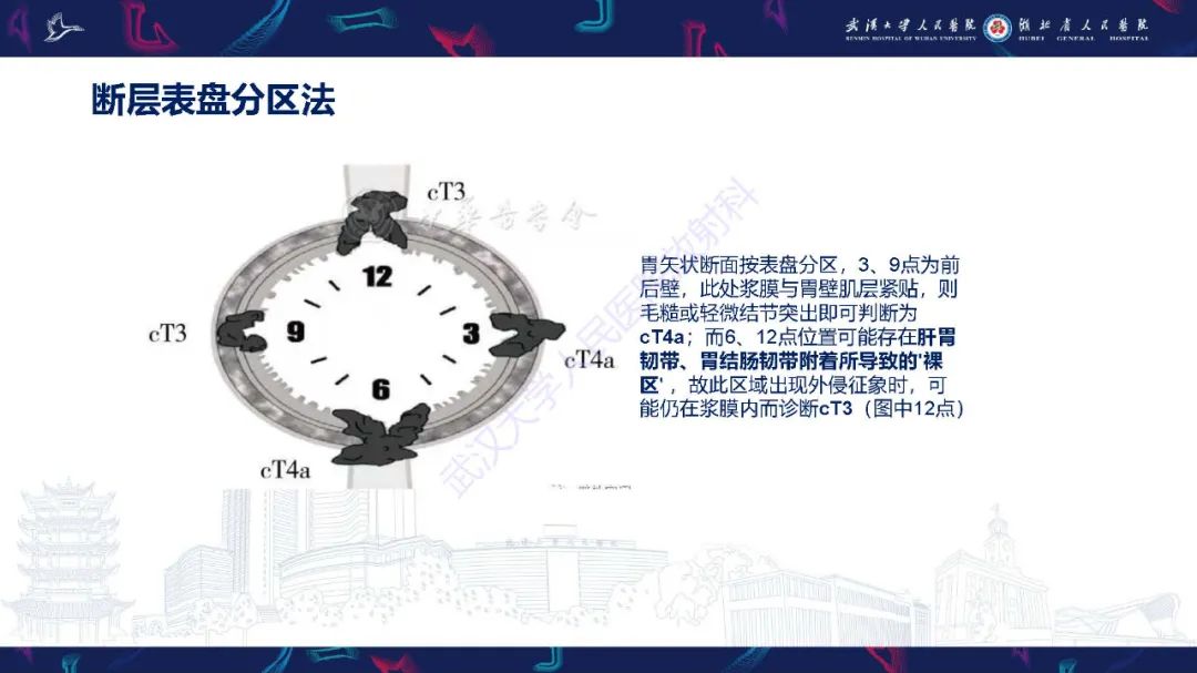 影像PPT - 【PPT】胃癌淋巴引流及TNM分期-30