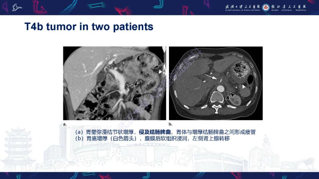 影像PPT - 【PPT】胃癌淋巴引流及TNM分期-31